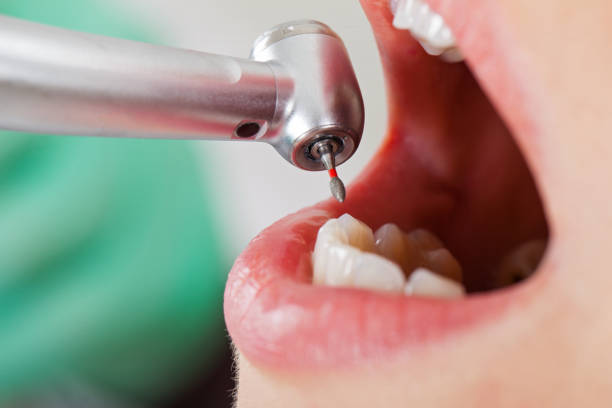 Best Broken or Chipped Tooth Repair in Fannett, TX